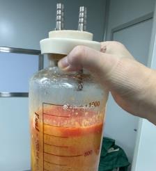 潍坊水动力吸脂手术要做多久？